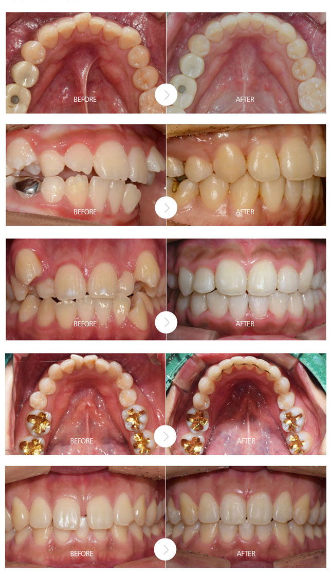 치아교정 전후사진