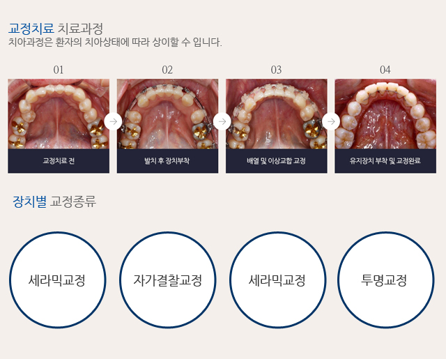 라이프치과 교정장치