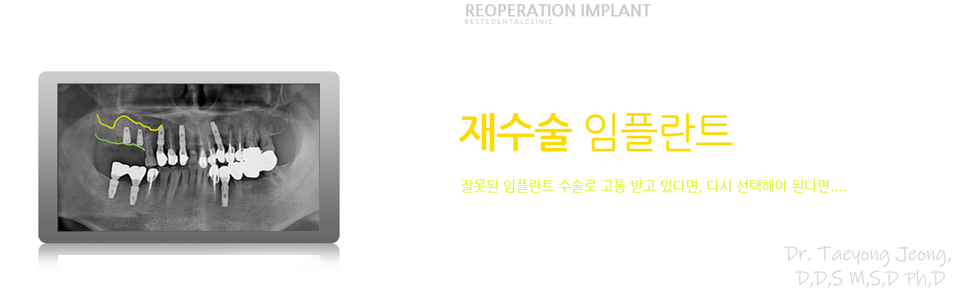 임플란트 재수술