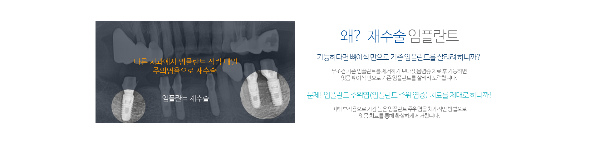 라이프치과 임플란트재수술