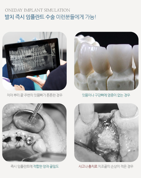 원데이임플란트 시스템